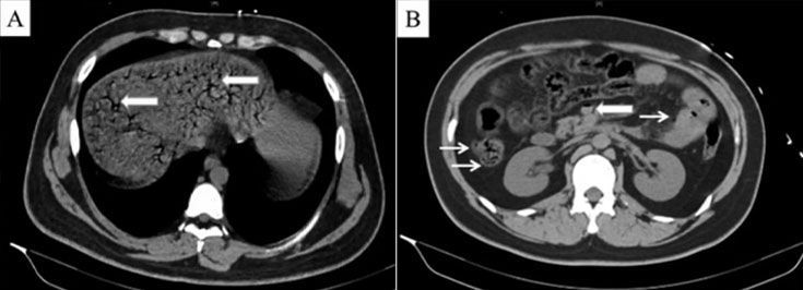 콜라 1.5L를 10분 만에 마신 중국 남성의 CT 결과. 장 등에 가스가 찬 모습을 화살표가 가리키고 있다./World News Today 유튜브