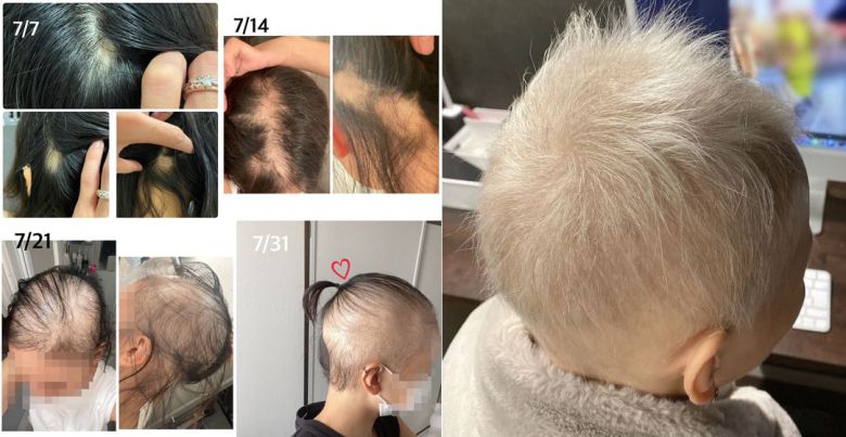 지난해 7월 A씨가 공개했던 탈모 진행 상황. 오른쪽 백발의 모습은 올해 2월이다. /A씨 블로그