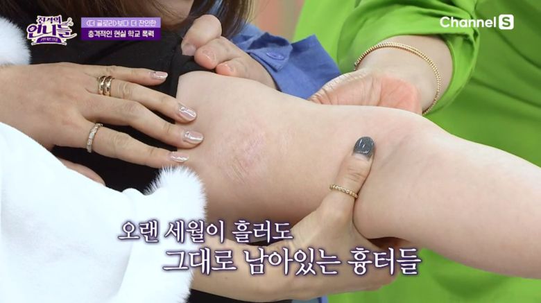박씨의 몸에 여전히 남아있는 고데기로 인한 흉터 자국. /채널S '진격의 언니들'