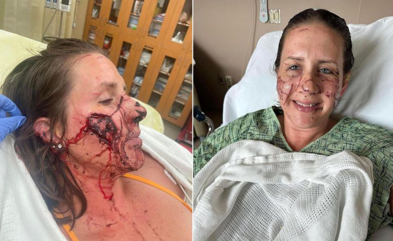 지난 2일(현지시각) 미국 몬태나주에서 물놀이를 하다 수달에게 공격을 받은 젠 로이스는 수술을 마치고 회복 중이다./페이스북