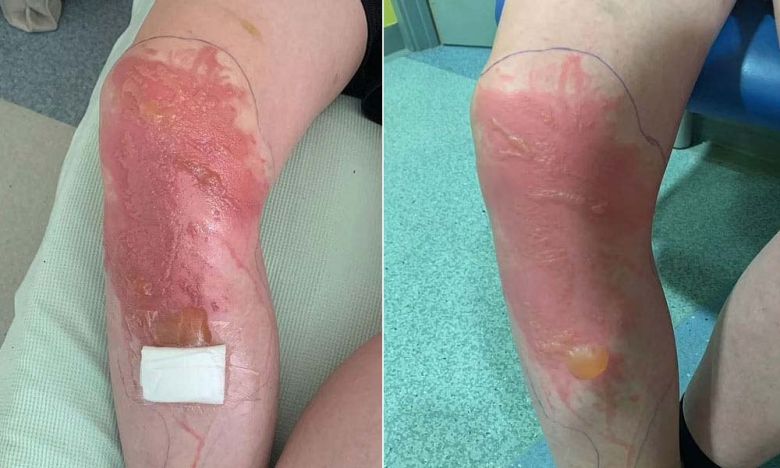 큰멧돼지풀에 스친 영국의 한 10대 소년 다리에 물집이 생긴 모습./데일리메일