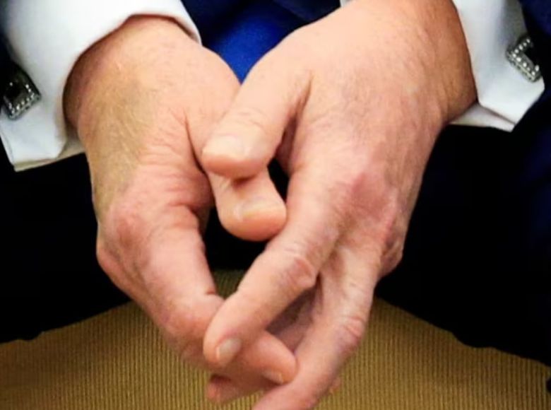 지난 2월 에마뉘엘 마크롱 프랑스 대통령과 정상회담을 한 도널드 트럼프 미국 대통령의 오른손에 포착된 큰 멍 자국./로이터 연합뉴스