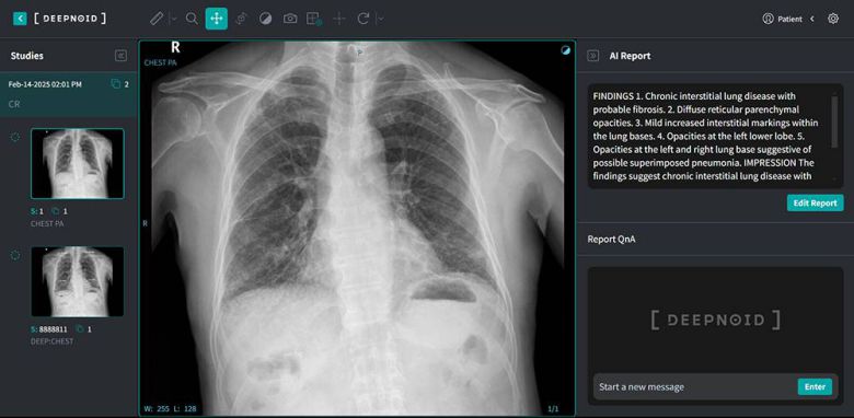 딥노이드의 흉부 엑스레이 데이터 분석 및 판독 소견서 생성 AI ‘M4CXR’, AI 판독 소견서 생성에 퓨리오사AI NPU가 도입될 예정이다 / 출처=딥노이드