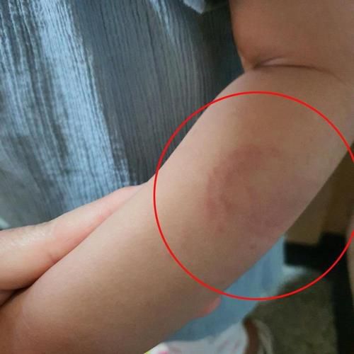 4살 여아 팔에서 발견된 깨물린 자국[독자 촬영 제공. 재판매 및 DB 금지]