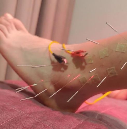 퉁퉁 부은 유영의 발목피겨스케이팅 유영은 지난달 올림픽 최종 선발전을 앞두고 스케이트를 신을 수 없을 정도로 심한 발목 통증에 시달렸던 것으로 알려졌다. 사진은 심하게 부은 유영의 발목. [유영 측 관계자 제공. 재배포 및 DB 금지]