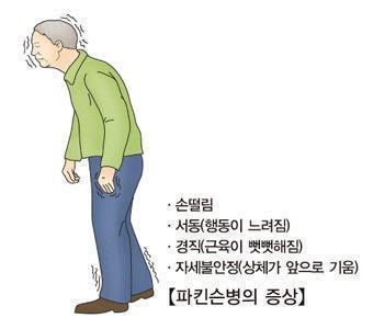 파킨슨병[출처: 서울아산병원]