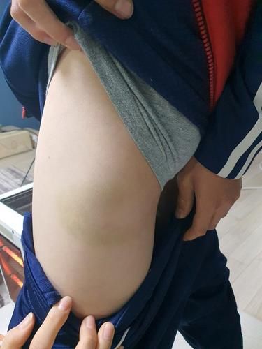 사건 발생일(3월 9일) 이후 사흘이 지난 3월 12일 촬영한 멍자국[고소인 측 제공. 재판매 및 DB 금지]