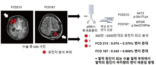 국소 피질이형성증 환자 유전 진단[KAIST 제공. 재판매 및 DB 금지]