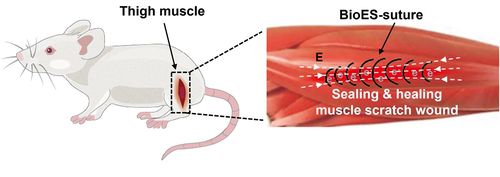 생체흡수성 전기자극 봉합사(BioES-suture) 치료[Zhouquan Sun and Chengyi Hou 제공. 재판매 및 DB 금지]