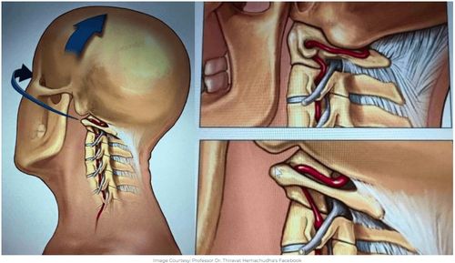 격렬한 목 마사지 시 목 혈관·신경 손상 우려[티라밧 헤마추다 교수 페이스북 캡처. 재판매 및 DB 금지]