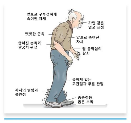 파킨슨병의 증상[대한파킨슨병 및 이상운동질환학회 제공]