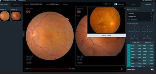VUNO Med®-Fundus AI사진 출처 : 홈페이지 캡처