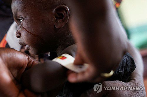영양실조 치료받는 어린이[로이터=연합뉴스 자료사진. 재판매 및 DB 금지]
