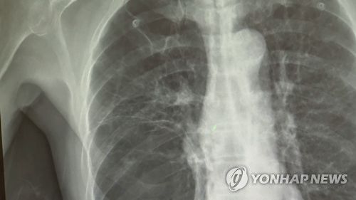 폐암 X-RAY[연합뉴스TV 제공]