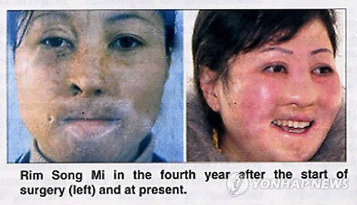 북한 여성 노동자의 성형수술 전후 사진    (서울=연합뉴스) 북한의 주간 영자신문이 2015년 공개한 사례. 2006년 평안북도 대관군의 공장 화재로 심각한 얼굴 화상을 당한 여성 노동자 림송미(28)가 8년에 걸친 성형수술로 외모를 회복했다. 평양타임스는 림송미의 4년 전과 현재의 얼굴을 나란히 비교하는 사진도 게재했다.