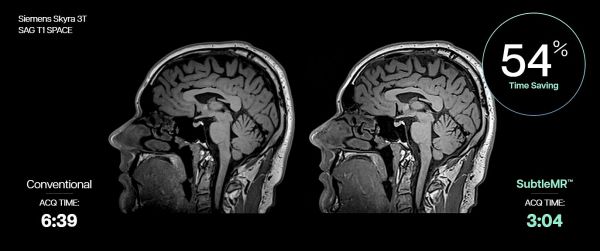 서틀엠알은 지멘스 헬시니어스 3.0T MRI ‘스카이라’(Skyra)의 뇌 시상면 방향 고해상도 3D T1 강조 영상(SAG T1 SPACE) 촬영 소요 시간(ACQ TIME)을 기존 6분 39초에서 3분 4초로 54% 단축했다.