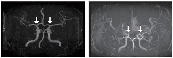 [사진 왼쪽부터] 정상 및 모야모야병 환자의 뇌혈관