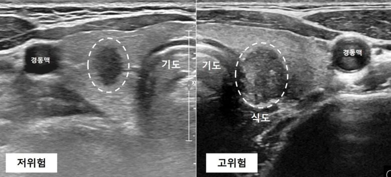 고위험과 저위험 ‘미세(갑상샘)유두암’. 서울대병원 제공