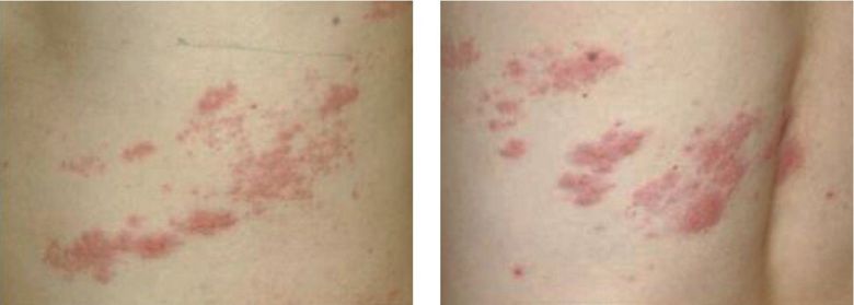 대상포진 수포는 일반적으로 붉은 반점이 몇 개 생긴 다음 여러 개가 띠 두르듯이 무리 지어 나타난다. 약 한 달 뒤 완치되지만, 상당수 환자에서 ‘대상포진 후 신경통’이 발병하기 때문에 대상포진 완치 뒤에도 주의를 기울여야 한다. 서울대병원 제공