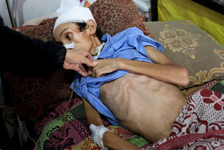 14살의 팔레스타인 소년 모사브 뎁스가 22일 팔레스타인 가자 지구의 알시파 병원에서 의료진으로부터 영양실조 판정을 받고, 침대에 누워 있다. 로이터 연합뉴스