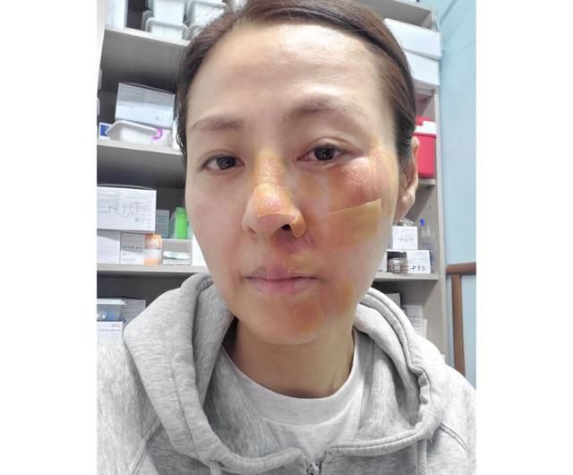 미스코리아 출신 배우 전혜진이 사고로 부상을 입었다고 밝혀 팬들의 우려가 짙어지고 있다. 전혜진 SNS