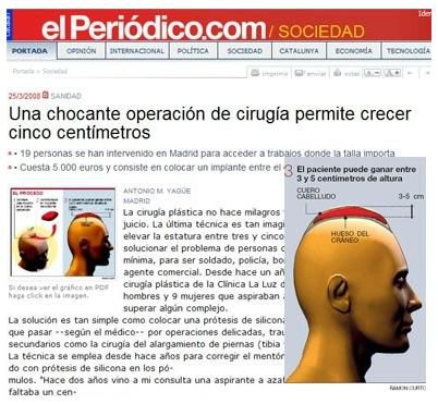 두피를 절개해 두개골과 두피 사이에 실리콘을 넣어 키를 키우는 수술. 스페인 언론 elPeriodico 갈무리