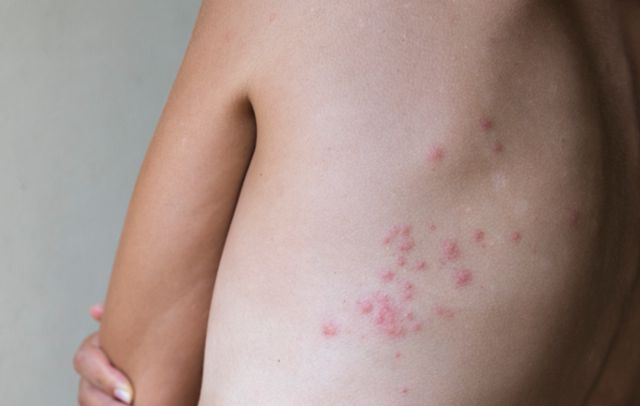 빈대에 물린 지 3일가량 지난 상처 모습. 빈대에 물리면 가려움증을 유발해 피부 감염을 일으킬 수 있다. 게티이미지뱅크