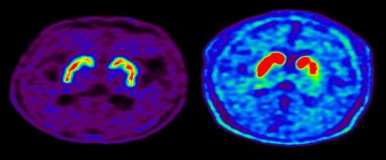 정상인의 뇌 핵의학 영상(도파민 분비 부위 활성·왼쪽)과 파킨슨병 환자의 뇌 핵의학 영상(도파민 분비 부위 퇴화).
