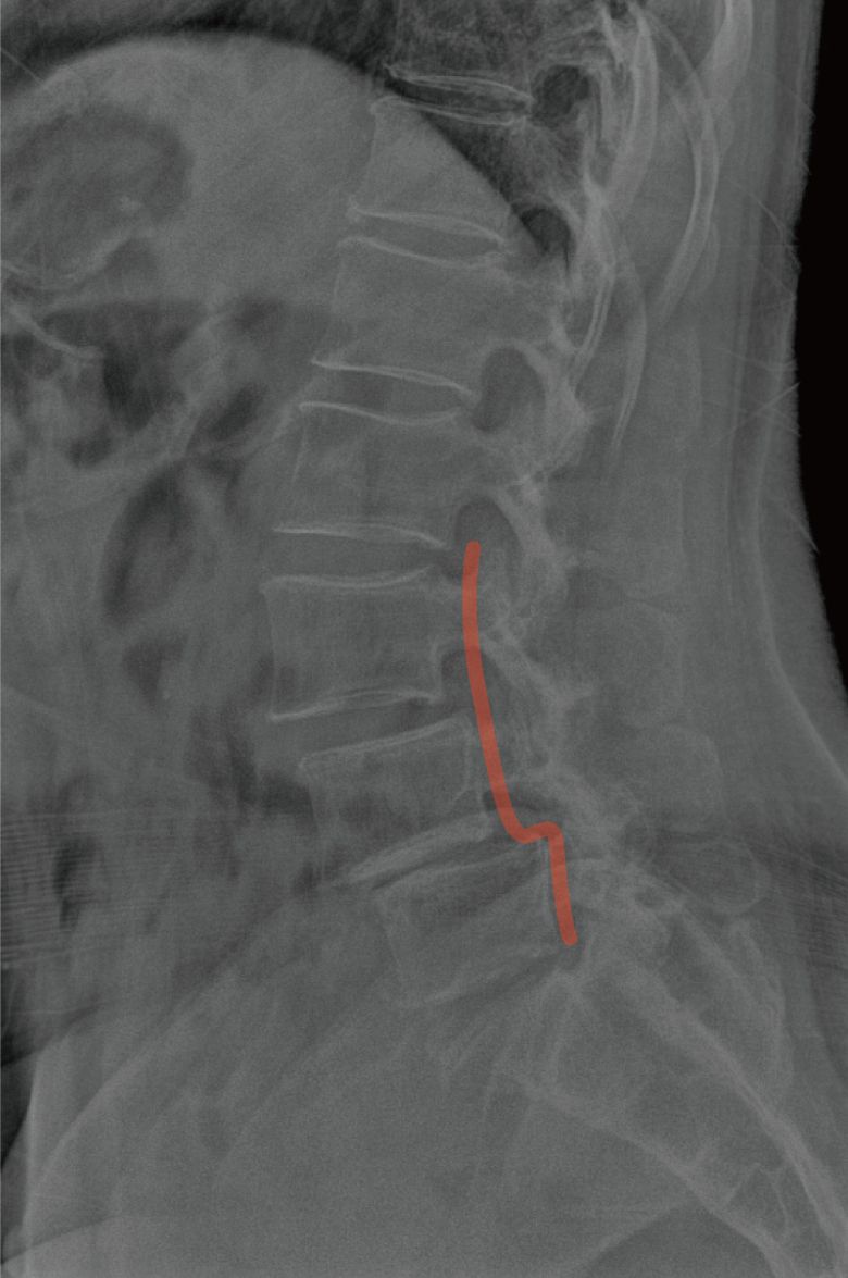 척추 전후방전위증 X레이 사진. 척추 하단쪽이 후방으로 빠져나와있다.