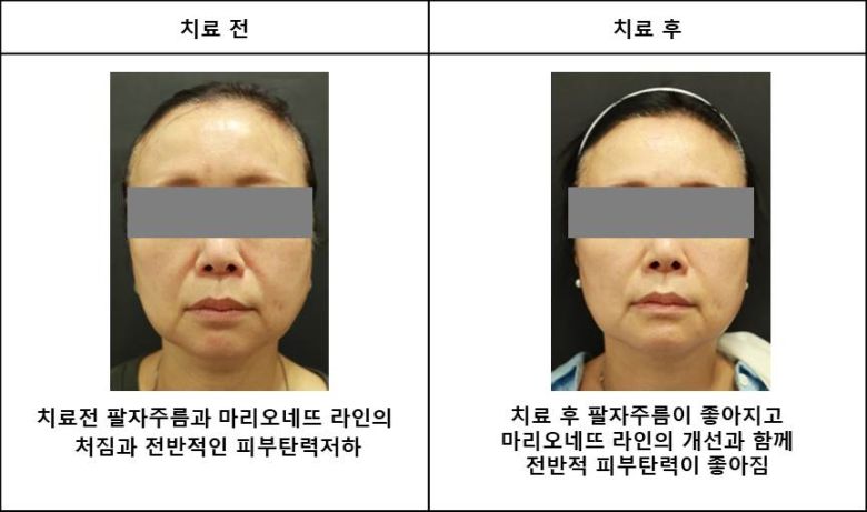 이상준원장은 “피부탄력레이저는 다운타임이 없어 일상 생활의 지장이 없이 치료받을 수 있지만 개개인의 피부상태에 적절하지 않은 치료를 할 경우 안면부 볼패임이나 화상 등이 발생할 수 있으므로 숙련된 의료진에게 치료를 받는 것이 필요하다”고 말했다.