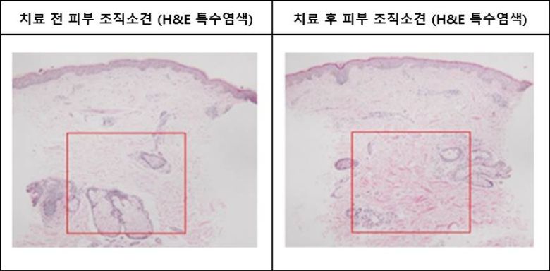 강남·분당 아름다운나라피부과는 이 임상 연구결과를 2023년 3월 뉴올리언스 에서 열리는 제 81차 미국피부과학회(AAD)에서 발표할 예정이다. 대표적인 주름 노화 치료법인 써마지와 울쎄라는 진피중하부와 근막층에 열에너지를 전달하여 탄력을 개선하는 반면 소프웨이브는 진피상부 및 중간층에 긴 막대형으로 열에너지를 전달하여 피부표면의 늘어짐과 주름을 개선하는 효과가 있어 기존의 치료와 병행하여 치료하면 더욱 시너지 효과를 볼 수 있다.