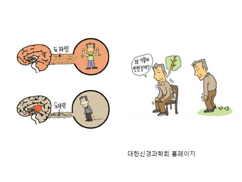 ▶ 수면 환경 개선 필요, 심한 렘수면장애는 약물 복용하기=수면장애도 파킨슨병 환자를 괴롭히는 대표적인 증상이다. 불면증을 해결하기 위해 수면 환경의 개선이 필요한데, 낮 동안 적당량의 햇빛을 쐬는 것이 좋고 수면 2~3시간 전이나 오후 8시 이후에는 TV시청이나 휴대폰, 인터넷 사용은 자제하는 것이 좋다. 또한 저녁에 미지근한 물로 샤워를 한 후 따뜻한 차를 한 잔하며, 독서나 조용한 클래식 음악을 청취하면 도움이 될 수 있다.