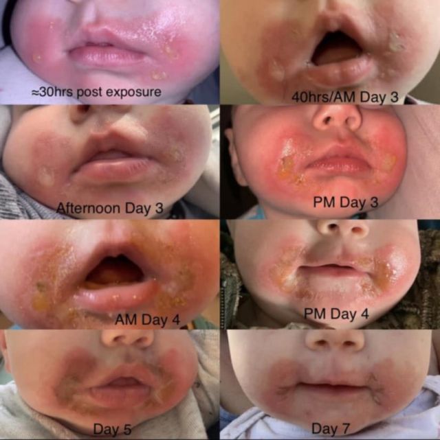 레나 벤자크가 3월 중순에 태양 아래에서 샐러리 줄기를 씹은 뒤 딸 아이가 마가리타 화상을 입은 뒤 증상을 날짜별로 기록했다. [레나 벤자크 SNS 갈무]