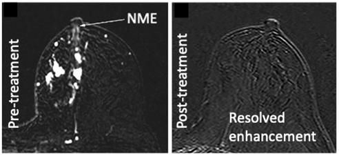 (좌) 선행항암화학요법 전 유방 MRI. 비종괴성 조영 증강의 유두-유륜 복합체 침범 소견이 관찰됨 (우) 선행항암화학요법 후 유방 MRI. 비종괴성 조영 증강의 유두-유륜 복합체 침범을 포함한 유방암 이 모두 사라진 소견이 관찰됨.