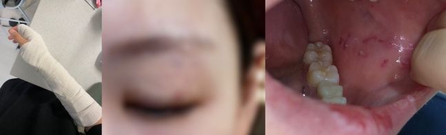 학생에게 폭행을 당한 서울 양천구의 한 초등학교 A교사의 피해 모습. [서울교사노동조합]