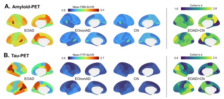 (그림) 조기 발병 알츠하이머 환자에서 아밀로이드(위)와 타우(아래) 축적양의 뇌지역적 분포.