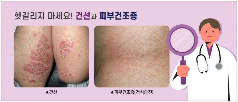 피부건조증은 피부에 수분을 공급하고 유지하는 것이 가장 중요하다. 치료는 염증의 유무로 달라지는데, 염증 소견 없이 건조한 피부만 있다면 보습제의 잦은 도포만으로도 개선할 수 있다. 목욕 기름과 오트밀 팩도 도움이 되는데, 목욕 후 3분 이내 즉시 충분한 양을 바르는 것이 좋다. 그러나 피부가 갈라지고 가려움증이 동반되었다면 가려움증을 완화 시켜주는 항히스타민제의 복용과 함께 병변 부위에 국소 스테로이드제를 함께 사용한다.