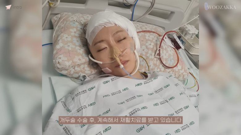 불의의 사고로 왼쪽 머리뼈 일부를 절개하는 수술을 한 우은빈 씨. [유튜브 채널 '우자까' 캡쳐]