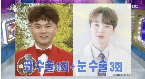 트로트가수 박서진의 성형 전과 후 모습. [MBC 방송화면 캡처]