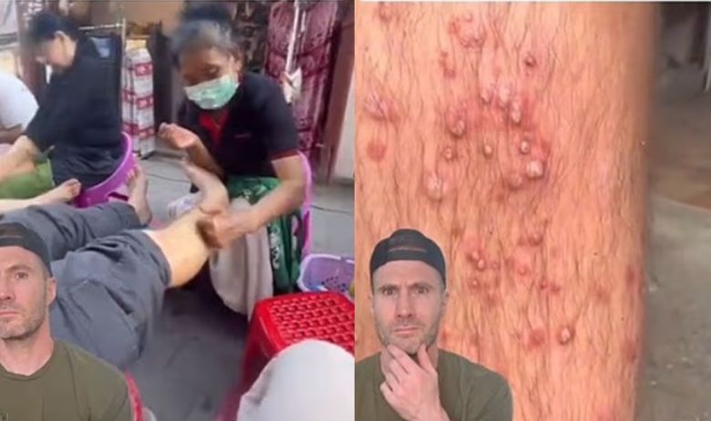 태국의 골목길에서 마사지를 받은 다음 다리에 흉측한 여드름이 생긴 남성 [조 휘팅턴 박사 소셜미디어]