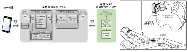 무선 OLED 콘택트렌즈를 활용한 망막전위도 검사 시스템의 모식도와 실제 검사 모습의 예시