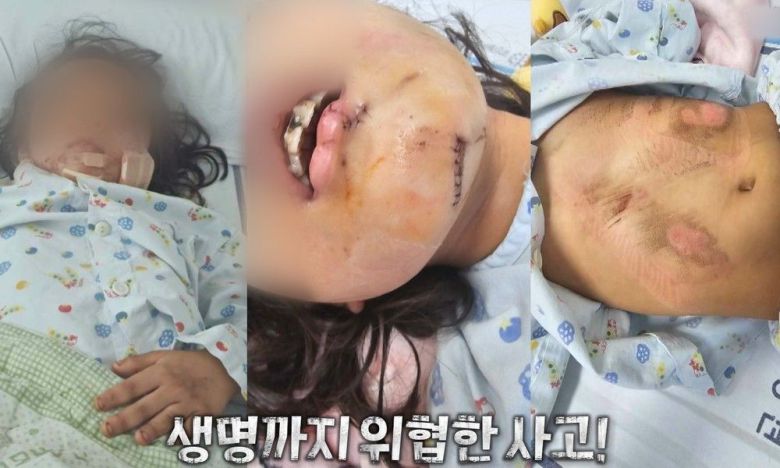 피해 아동이 다친 모습. [MBC ‘실화탐사대’ 갈무리]