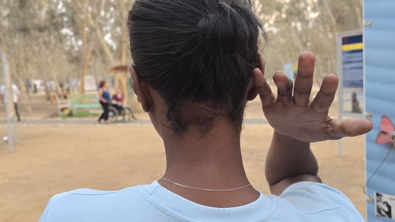 지난 11일 노바 음악 페스티벌 생존자 마잘 타자조씨가 하마스 무장대원의 소총 개머리판으로 뒷목를 맞아 상처가 난 모습 [(스데롯)=천예선 기자]