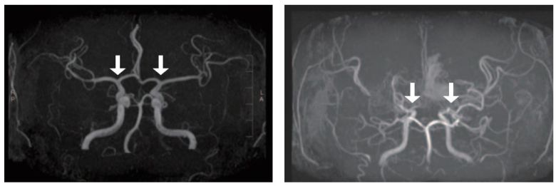 [사진 왼쪽부터] 정상 및 모야모야병 환자의 뇌혈관