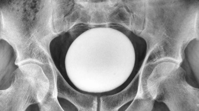 이란 35세 남성의 방광에서 발견된 타조알 크기의 결석. [라이브사이언스]