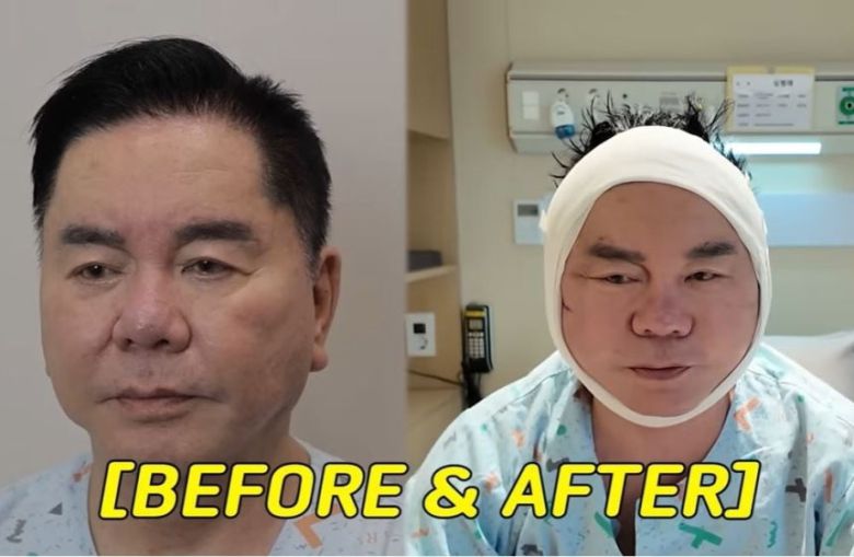 개그맨 심형래가 안면거상술을 받은 모습[심형래 유튜브 채널 ‘영구TV’]