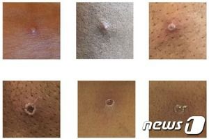 영국 보건안전청이 제공한 원숭이 두창 환자의 피부 발진 사진. © 뉴스1 (영국 보건안전청, UKHSA)