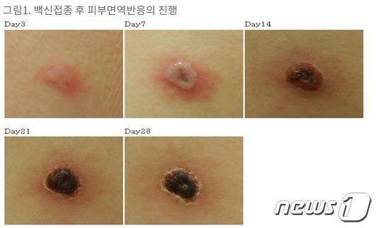 국내 두창 백신접종 후 피부면역반응의 진행 (식품의약품안전처 '이노엔세포배양건조두창백신주' 의약품 정보화면 캡처) © 뉴스1
