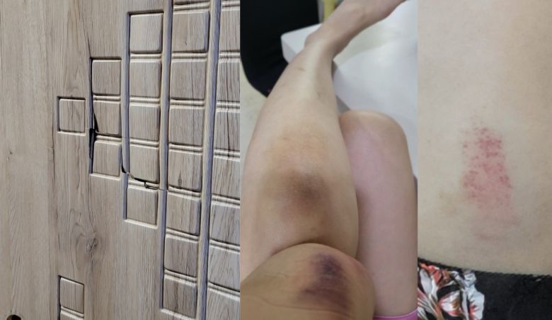 안혜림 씨가 김학배 씨에게 폭행당했다고 주장하며 올린 증거 사진. (블로그 갈무리)