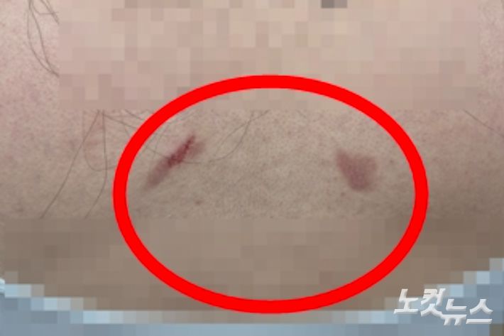 소비자 B씨는 제품 사용 직후 피부가 찢어지는 상처를 입고 흉터로 남았다고 고통을 호소했다. B씨 제공